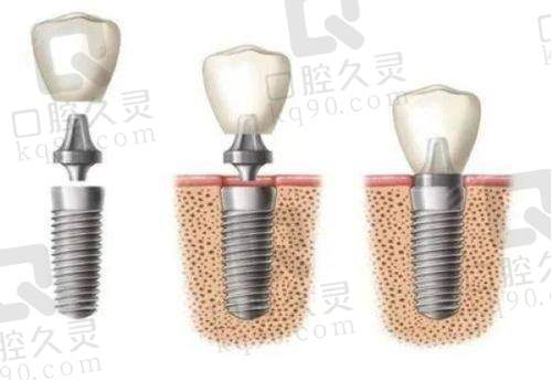 二、兰州诺贝尔口腔种牙价格表详情