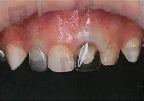 郑州植得口腔医院儿童后牙区预成冠有什么作用？