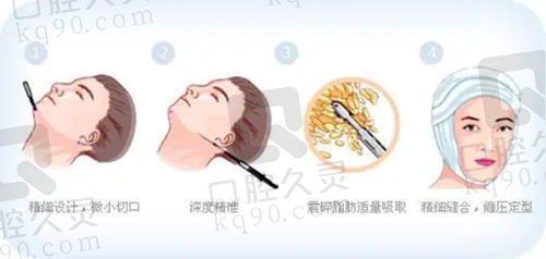 合肥亚典医疗美容门诊部靠谱吗？割双眼皮、隆鼻等多项目效果好，顾客评价佳