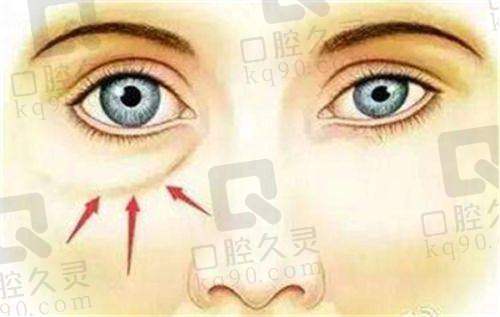 吸脂项目解析