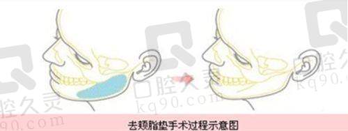 苏敬达大脚骨矫正服务