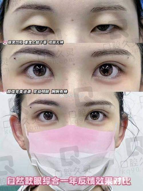深圳李鹏医生修复怎么样？十余年眼修复经验，助您重塑眼部自然之美！ 