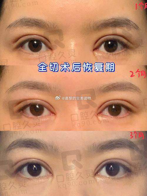 三、孙景波特色眼整形项目