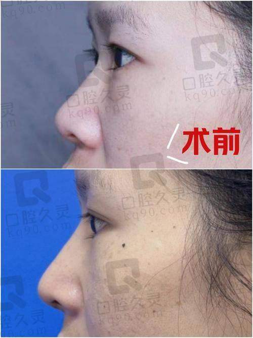 谭超医生隆鼻怎么样？精细化操作无痕自然，性价比高受年轻群体青睐！ 