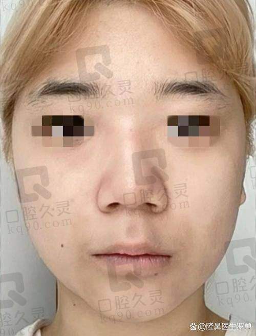 三、田芳斌医生鼻子实例分享
