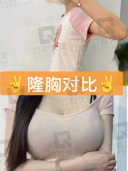 广州壹加壹美容医院傲诺拉假体隆胸医生推荐项美连及价格详解56750元起，胸部将呈现自然的饱满感！