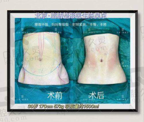 李政文医生吸脂多少钱？其独创微针隐形吸脂术，面部吸脂恢复快价格区间受关注 