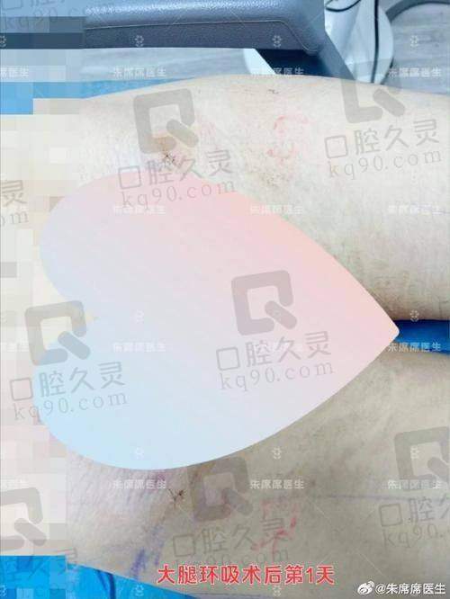 二、深圳陈群腹壁成形技术特色