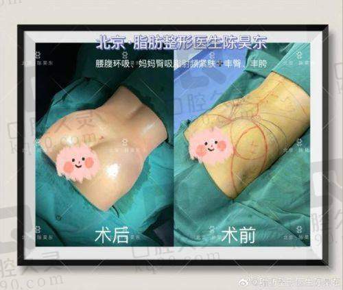 五、腹壁成形手术实例及反馈