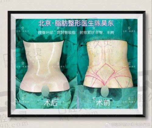 孙延辉吸脂怎么样？技术娴熟、方案个性，术后指导贴心获众多顾客积极好评！ 