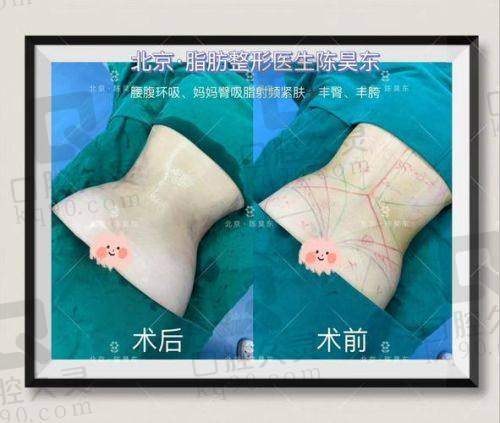 六、选择深圳陈群腹壁成形的注意事项