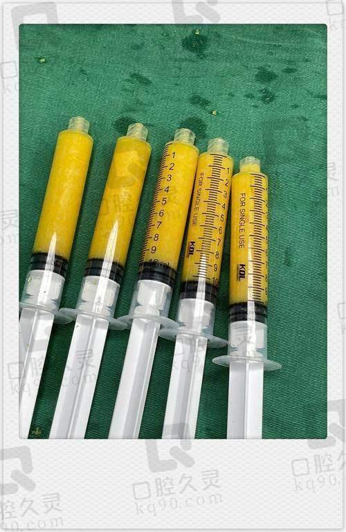 深圳陈群腹壁成形怎么样?精湛技术、创新方案,助您实现腹部完美塑形与高满意度