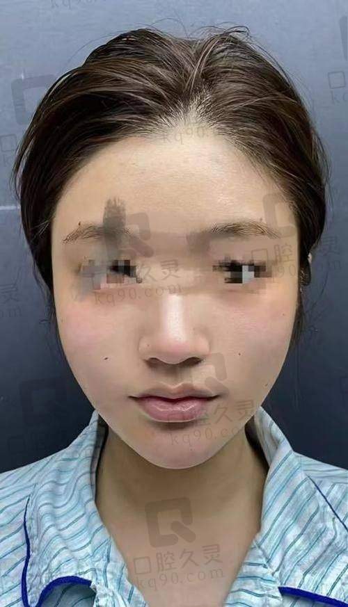 脂肪填充面部多少钱左右？