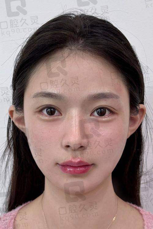 三、嗨体去颈纹的成效和维持时间