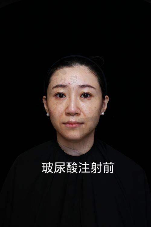 重庆注射幼态脸价格参考