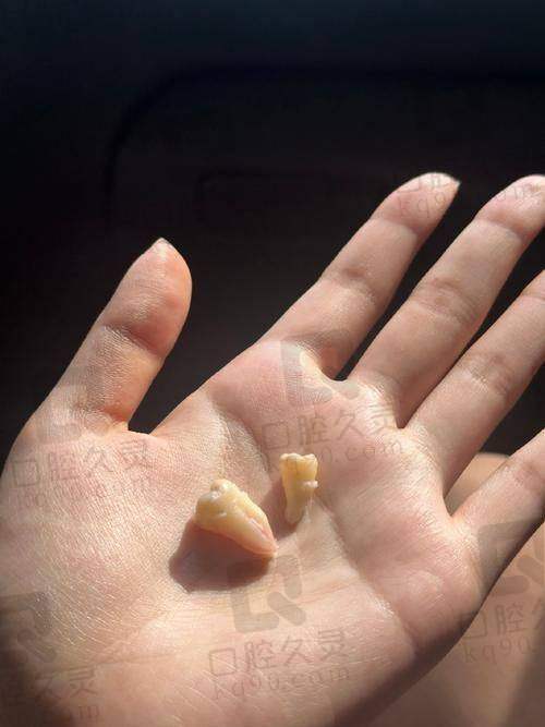 西安双宝口腔医院上颌智齿拔除项目优势