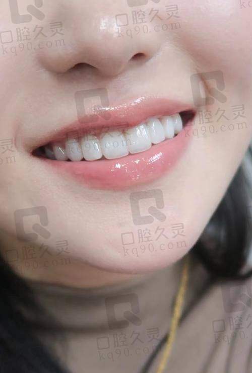 上海薇琳伯曼口腔瑞士EMAX全瓷贴面780元起，正规低价打造牙齿美学奇迹