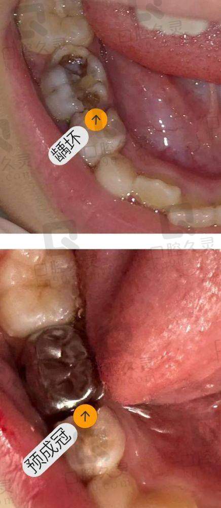 郑州植得口腔医院儿童后牙区预成冠是什么技术？