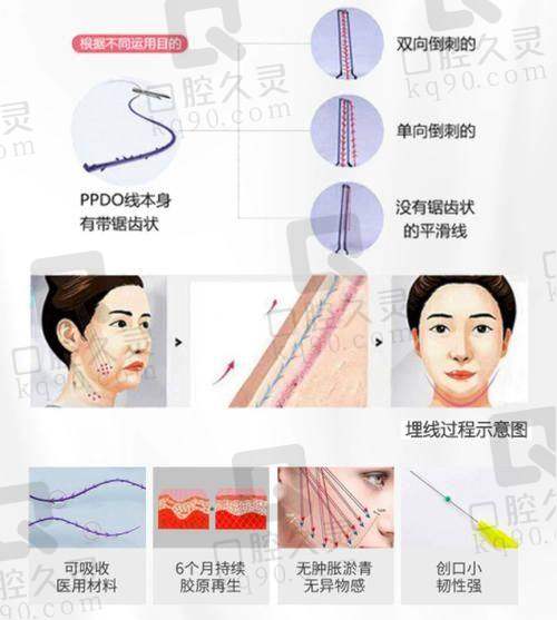 广州壹加壹美容医院李明埋线提升19750元起，修复提拉成效，减缓衰老迹象