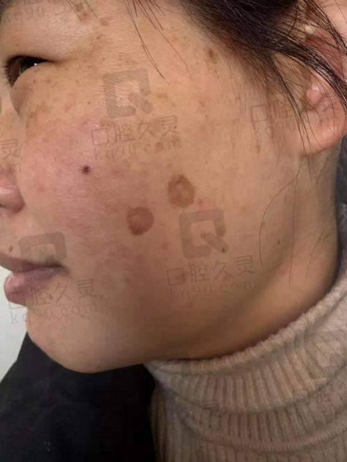 廊坊紫石医疗美容门诊部：以其不错的激光祛斑技术受到了众多患者的好评。门诊部的医生会在治疗前与患者进行充分的沟通，了解患者的需求和期望，然后制定出科学合理的治疗方案。在治疗过程中，严格把控激光的参数和能量，确保治疗的安心性和有效性。