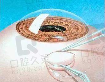 汕尾爱尔眼科医院的手术设备优势