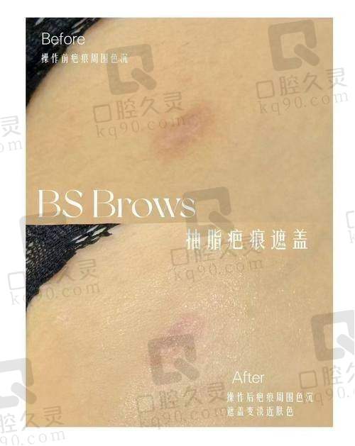 六、武汉正璞瘢痕整复医院收费价格明细