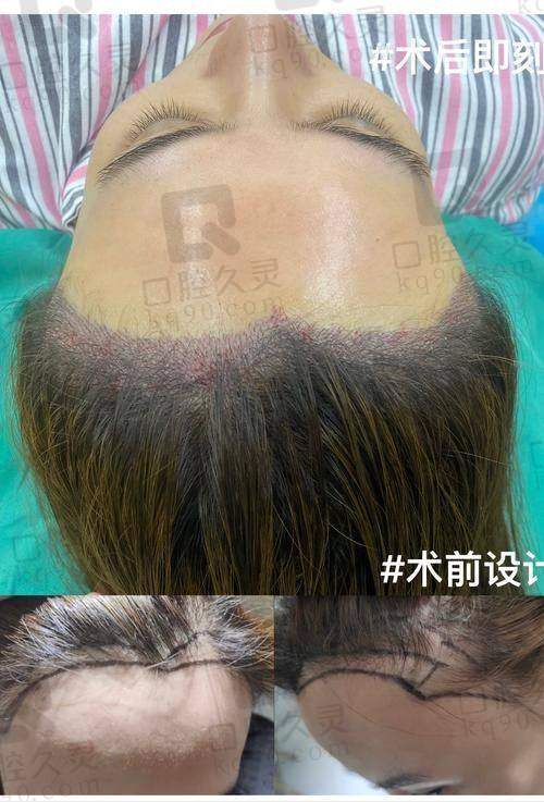 北京碧莲盛医院发际线种植12800元起，重塑完美发际线开启自信新人生！ 