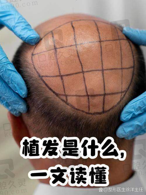 池州正规植发医院哪家好？地址在哪？