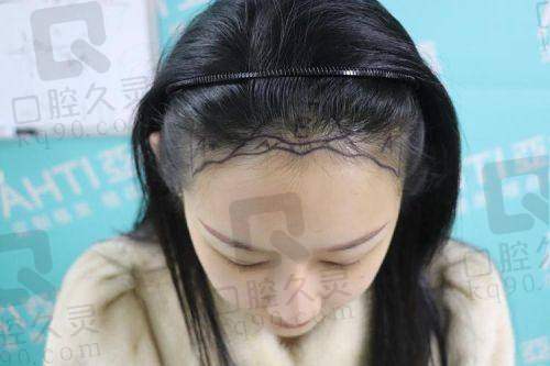 北京碧莲盛头顶加密的成效如何？