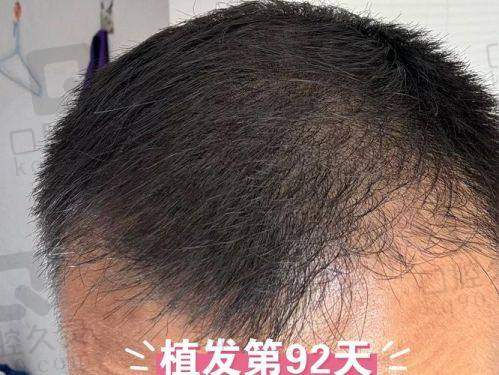 北京碧莲盛头顶加密体验分享，改善稀疏问题，术后发量增多让我自信满满 