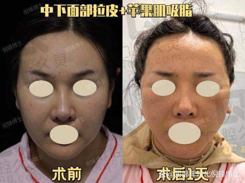 选择北京加减美做拉皮手术安心吗？
