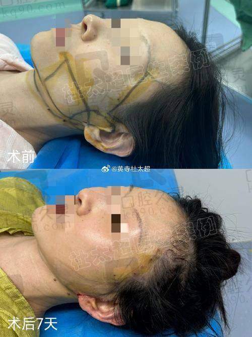 北京穆宝安医生做面部提升手术的价格合理吗？