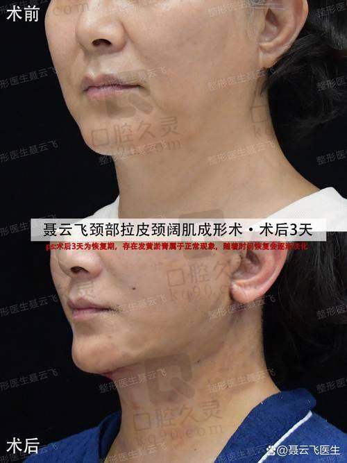 北京穆宝安医生做面部提升手术的安心性有保护吗？