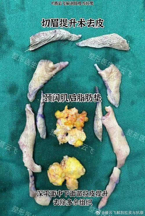 北京加减美拉皮手术后如何护理？