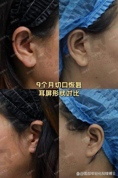 北京穆宝安医生做面部提升手术的技术怎么样？