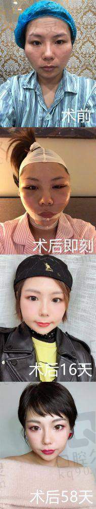 张立天：北京圣嘉新的磨骨高手