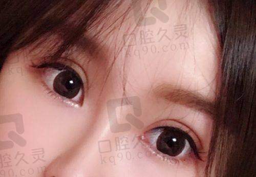郑京湘双眼皮案例大揭秘!长沙亚韩资深医师,小创口打造自然美眼好评不断!