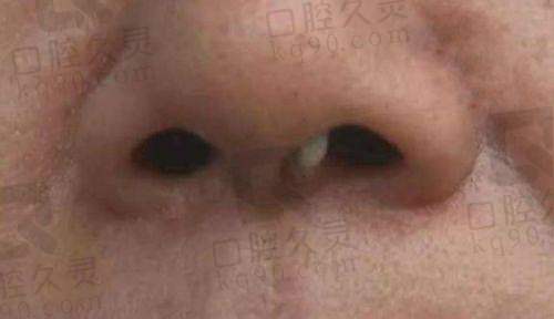 吴振医生做鼻子的价格情况