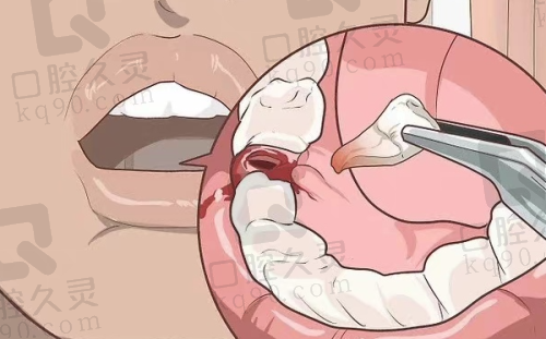 医生不建议拔掉乳牙滞留的原因二：自然脱落的可能性