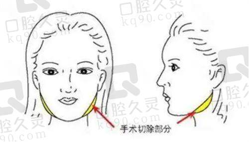 三、实例分享：深圳美莱整形医院口碑如何