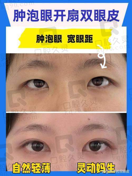 三、郑京湘双眼皮成功实例展示