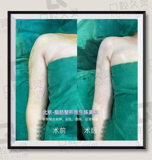 北京联合丽格第二医院陈昊东医生吸脂怎么样？