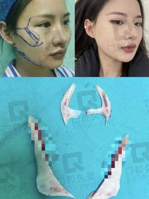 广州广大医院和华西医院哪个做凸嘴正颌手术好？华西医院与广大医院哪个更值得信赖？