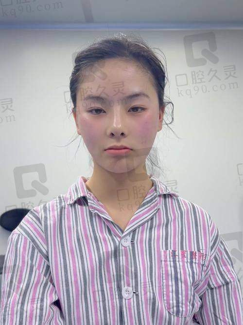 成都友谊整形颧骨内推+颧弓降低42800元起，赵延峰及李继华打造自然精致脸型