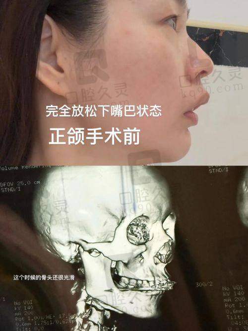 2. 双颌正颌手术价格