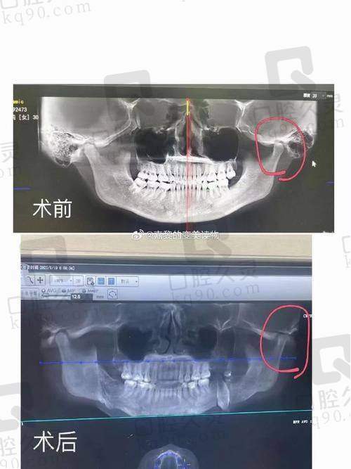 李运峰正颌手术成功率高吗？超3000例成功实例、98.7%满意度给出肯定答案！ 