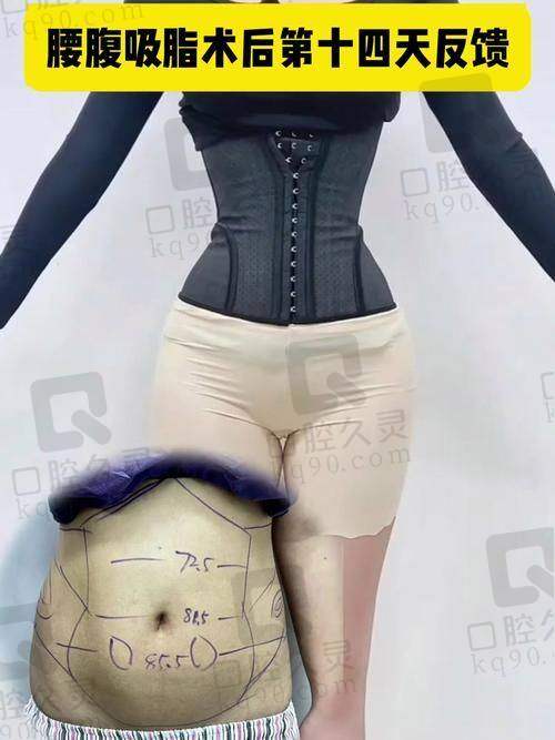 找广州军美整形王世虎院长全身吸脂成功上岸！告别赘肉实现身材蜕变找回自信魅力