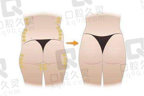 深圳地区排名前十的吸脂医生都有谁？