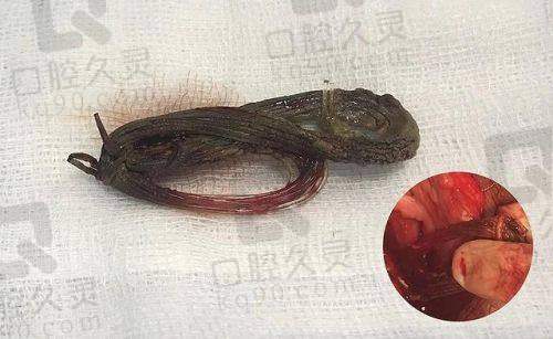 哈尔滨羽禅的异物取出服务质量如何？