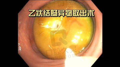 哈尔滨羽禅在异物取出方面有哪些特色技术？